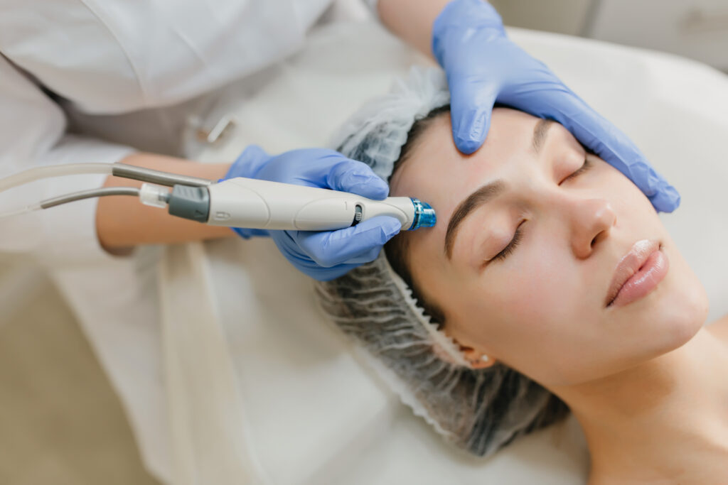 Discover the Power of SQT Microneedling in London: A Revolutionary Skin Renewal Treatment
